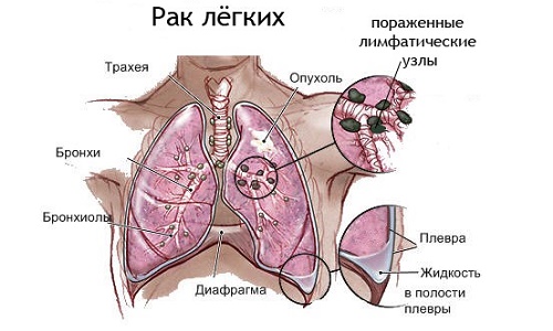 Схема рака легких
