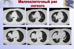 Мелкоклеточный рак легкого на рентгеновском снимке
